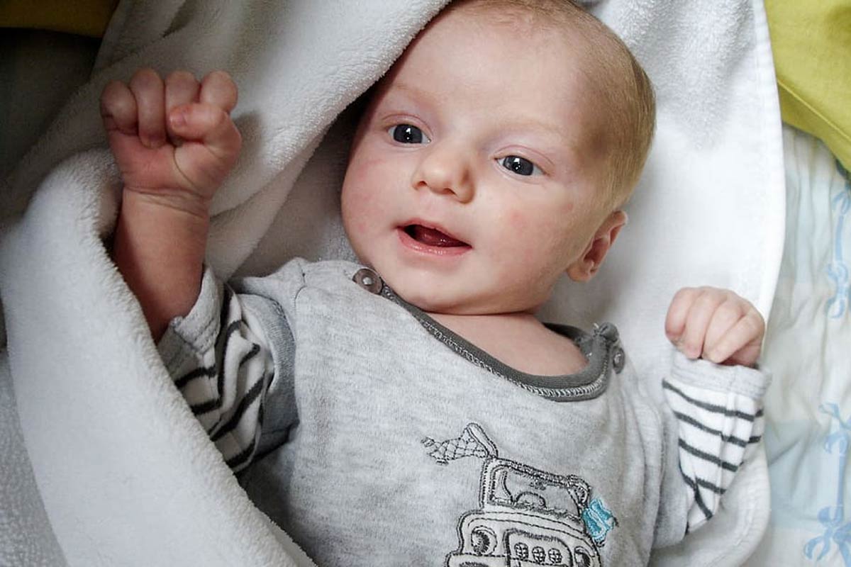 baby acne cheeks