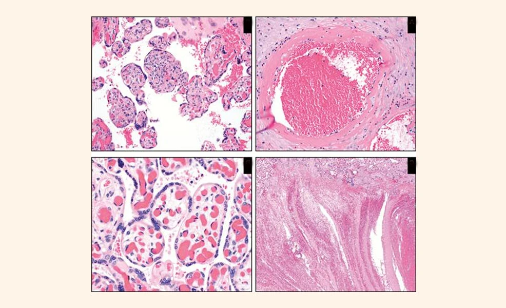 placenta pathology in covid
