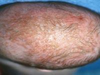 cradle cap on baby pictures