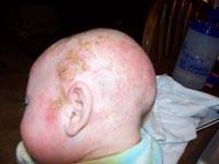 cradle cap on baby pictures