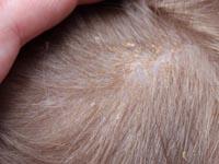 cradle cap on baby pictures