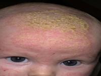 cradle cap on baby pictures