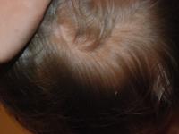 cradle cap on baby pictures