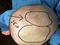 cradle cap on baby pictures