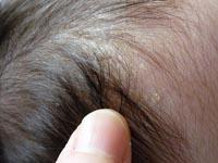 cradle cap on baby pictures