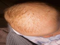 cradle cap on baby pictures