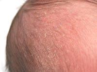 cradle cap on baby pictures