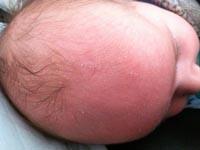 cradle cap on baby pictures