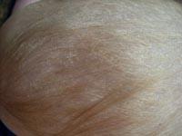 cradle cap on baby pictures