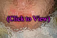 diaper rash on baby