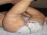 eczema rash on baby