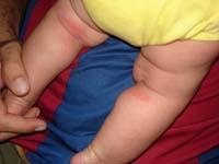 eczema rash on baby