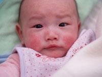 eczema rash on baby