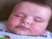 eczema rash on baby