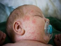 heat rash on baby