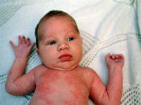 heat rash on baby
