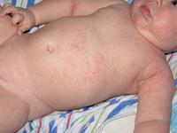 heat rash on baby