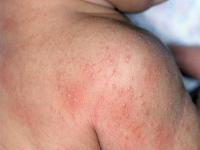 heat rash on baby