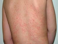 heat rash on baby