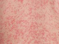 heat rash on baby