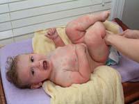 hives on baby
