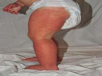 hives on baby