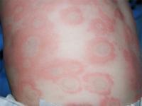 hives on baby