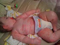 hives on baby