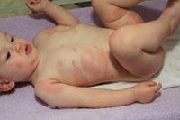 hives on baby