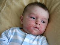 impetigo rash on baby