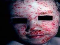 impetigo rash on baby