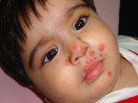 impetigo rash on baby