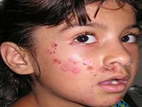 impetigo rash on baby