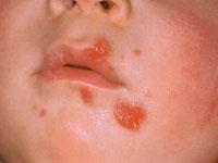 impetigo rash on baby