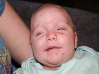 chickenpox on baby rash