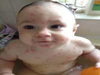 chickenpox rash on baby