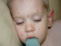 chickenpox on baby rash