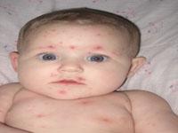 chickenpox on baby rash