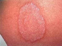 ringworm rash on baby
