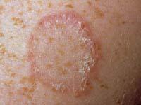 ringworm rash on baby