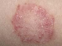 ringworm rash on baby