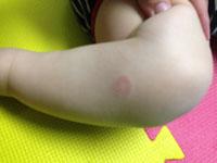 ringworm rash on baby