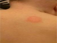 ringworm rash on baby