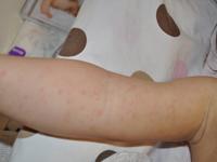 roseola on baby