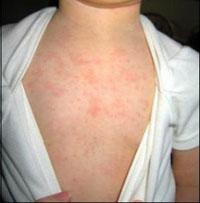 roseola on baby