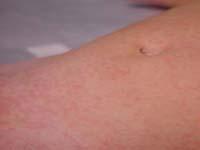 viral rash on baby
