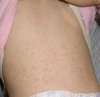 viral rash on baby