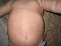 viral rash on baby