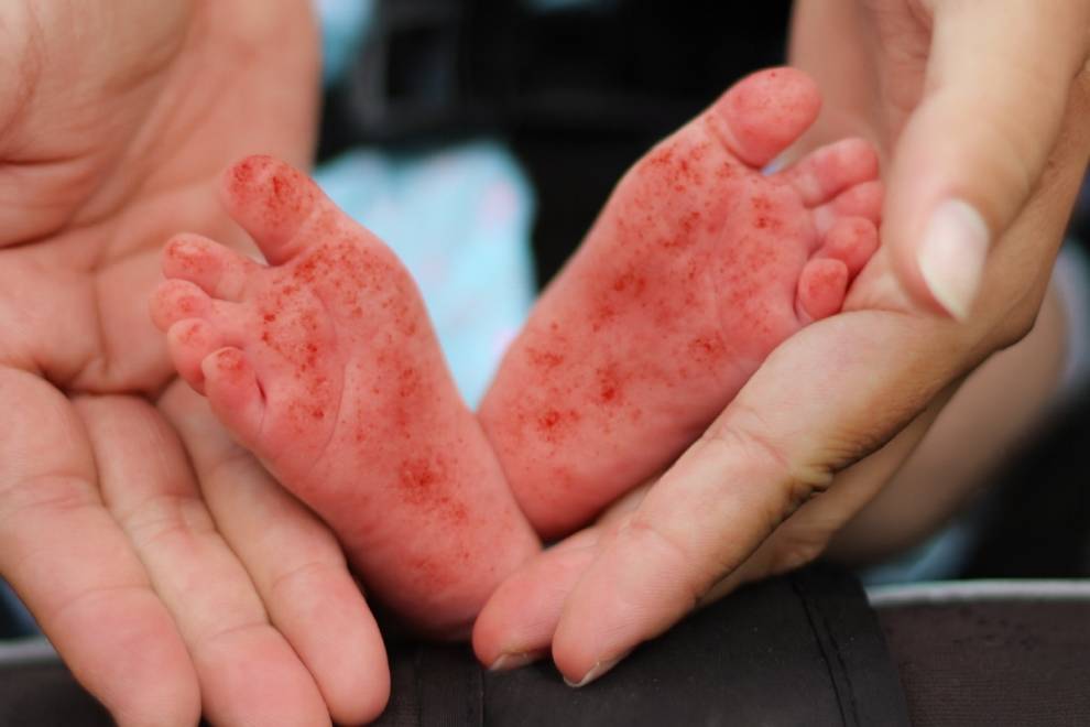 Baby Rash Pictures, Causes, Treatments