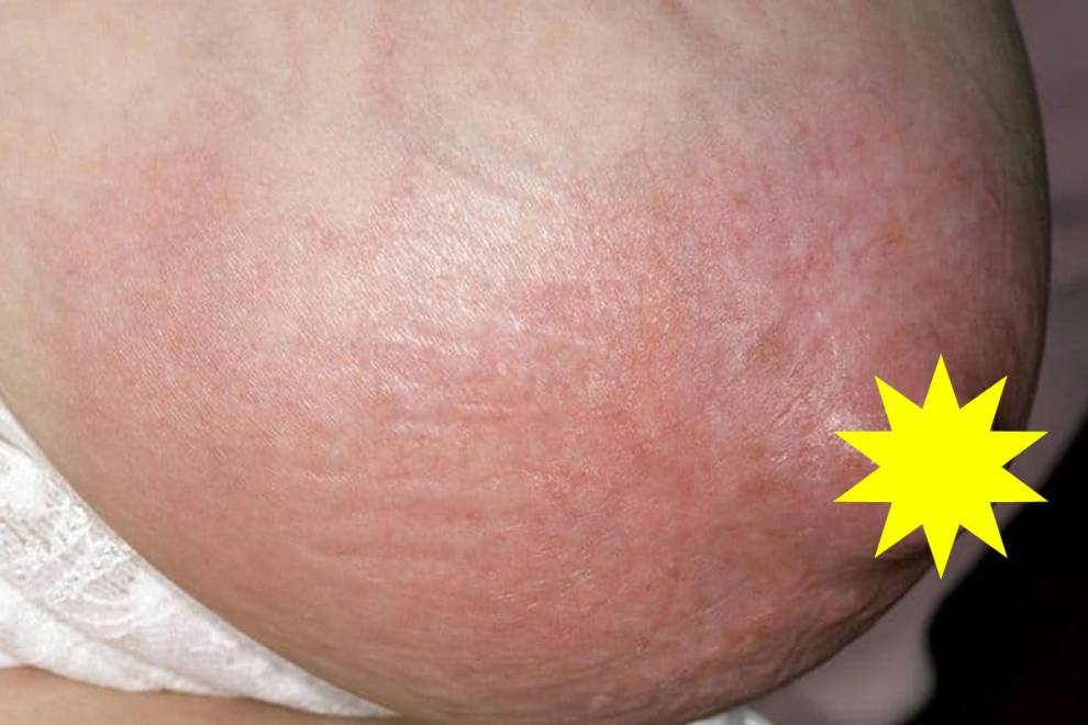 Breast Engorgement During Breastfeeding